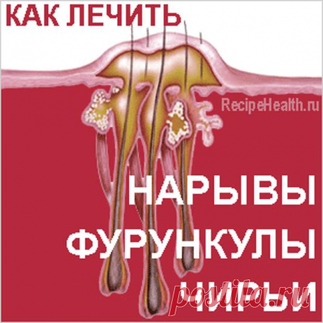 Нарывы, фурункулы, чирьи: народные средства лечения.