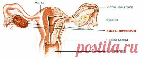 ЛЕЧИМСЯ ДОМА-ИЗБАВЛЯЕМСЯ ОТ КИСТЫ ЯИЧНИКА