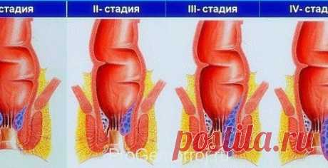 Геморрой. Как справиться с болезнью