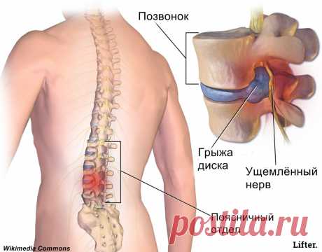 Комплекс ежедневных упражнений при грыже