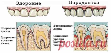 Пародонтоз болючий перестанет мучить. До глубокой старости будем грызть орехи, если применяем мы рецепты эти | Краше Всех