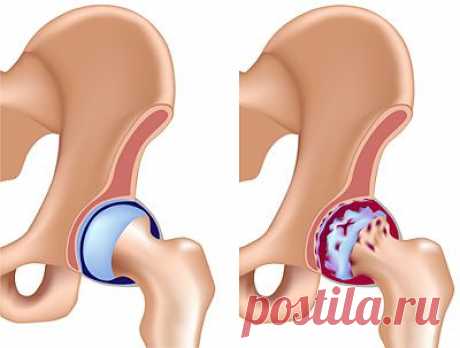 Лечение коксартроза - лечение артроза тазобедренного сустава.