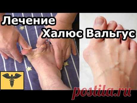 Hallux valgus | Халюс Вальгус | Искривление пальцев ног | Быстрое лечение | доктор Божьев
