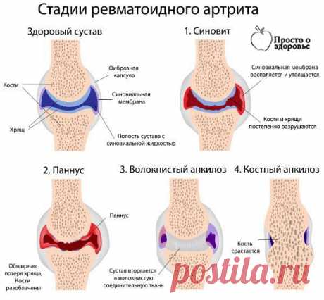 СУПЕРЛЕЧЕНИЕ - КАРТОФЕЛЬ НА КЕФИРЕ ПРОТИВ АРТРИТА