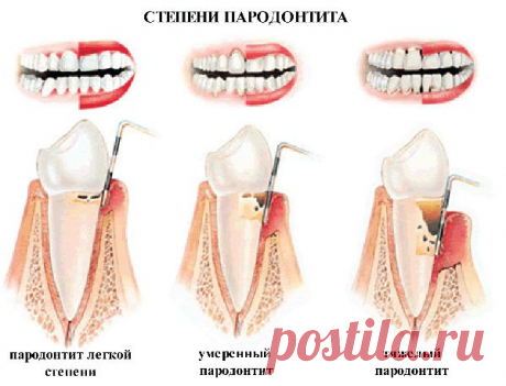 Что такое пародонтоз - причины, симптомы и лечение