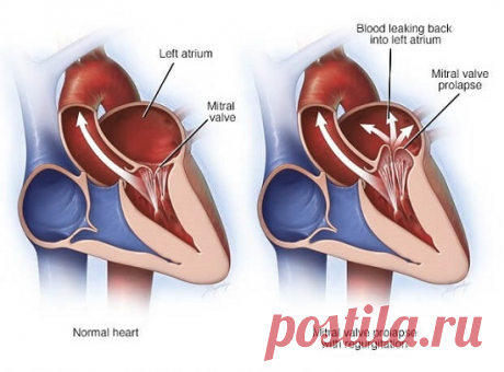 Чем опасен пролапс митрального клапана и что это такое? Симптомы, причины, лечение