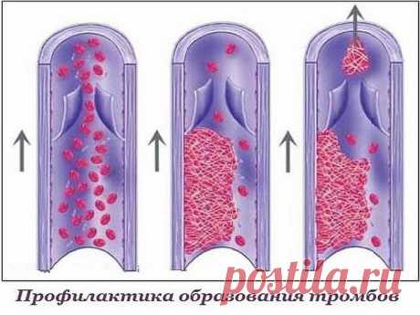 Профилактика образования тромбов.