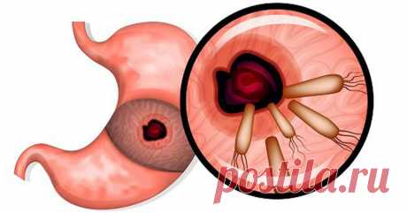 7 мощных средств убивают бактерии, которые вызывают рак желудка, язвы, гастрит, вздутие живота, аллергию и не только Я избавилась от гастрита, который лечила в течение 5 лет, просто и быстро! Жалею, что не знала этого раньше!