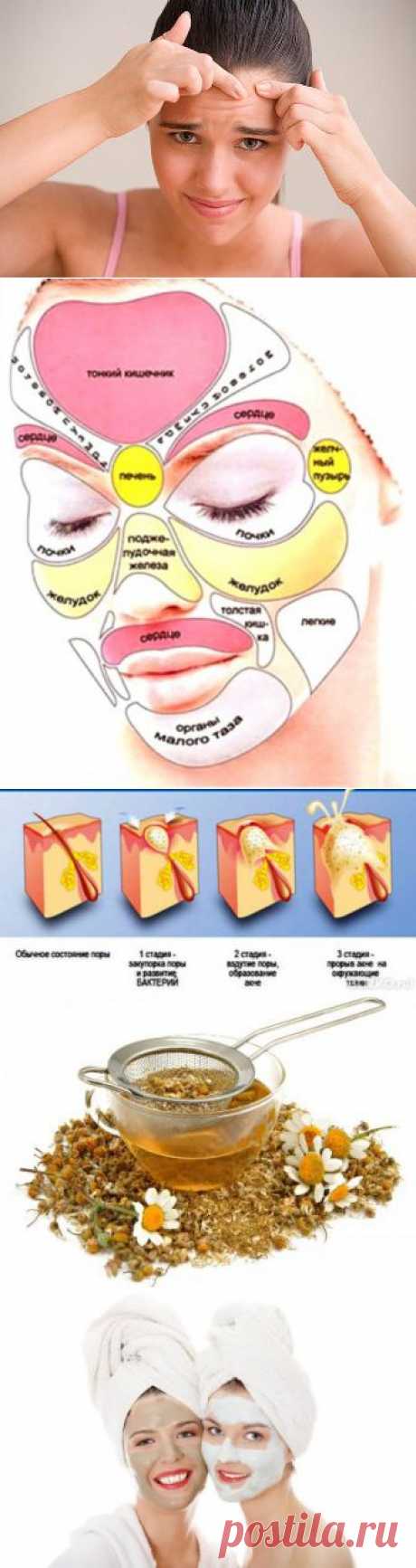 (+1) тема - Средства и методы борьбы с прыщами на лице | ВСЕГДА В ФОРМЕ!