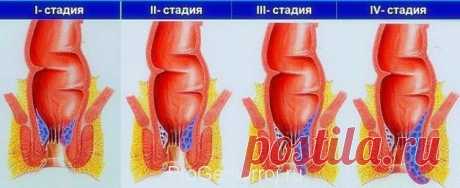 Геморрой. Как справиться с болезнью