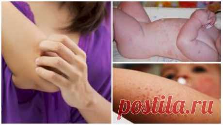 Лечение аллергии на укусы комаров у детей и взрослых