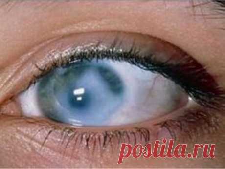 Глаукома - симптомы, причины, диагностика, лечение, операция и капли от глаукомы