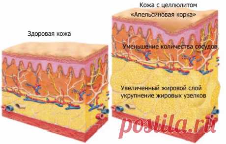 Целлюлит: массаж в домашних условиях, комплекс упражнений и обертывания
Если возник целлюлит, массаж в домашних условиях может исправить проблему, но ведущую роль играют упражнения. Целлюлит – это не накопленные токсины или застоявшаяся кровь, это просто жировые отложения, в результате из-за особенностей строения жировой ткани у женщин кожа выглядит бугристой.
Целлюлит появляется без какой-либо причины, и с возрастом шанс получить апельсиновую корку увеличивается. Соединит...