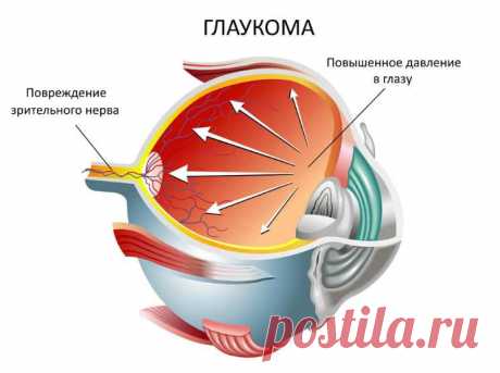 Глаукома — народные рецепты лечения коварного недуга. Будут глаза здоровы