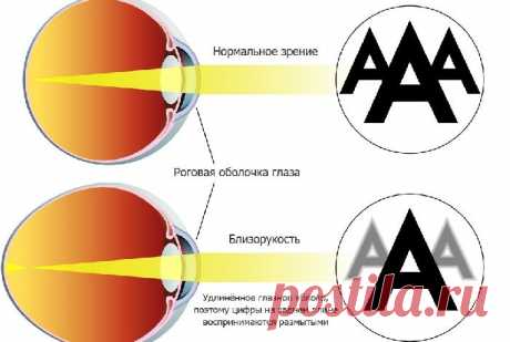 Как можно улучшить зрение при разной степени близорукости