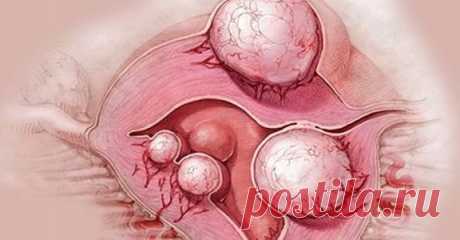 Народные средства от кисты и миомы Этому заболеванию подвержены тысячи женщин во всем мире! Натуральные рецепты помогают успешно избавиться от него!
Эти кисты и миомы обычно появляются без видимой причины. Несмотря на то, что миомы и к…