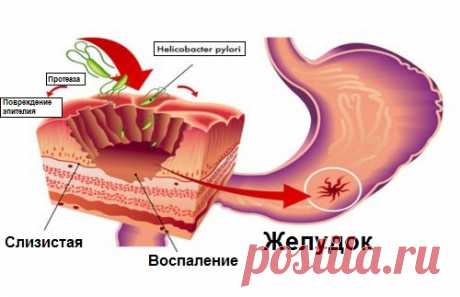 Натуральные средства против бактерии Helicobacter Pylori - Шаг к Здоровью