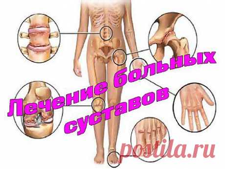 В данном видео подробно показано как лечить больные суставы на профессиональном уровне. Система лечения работает отлично и проверено многолетней практикой.

Все ревматические заболевания, будь то артроз, артрит, подагра дают о себе знать как в холодное время года, так и в жару. Летом, чаще всего они проявляются у тех, кто много времени проводит на пляже. Зимой и осенью обострения случаются из-за переохлаждения организма. Многое, конечно, еще зависит и от образа жизни, питания и ............