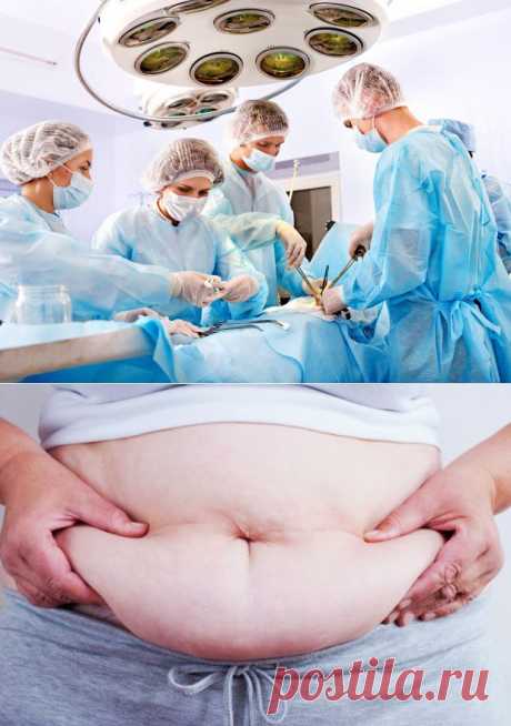 (+1) тема - 6 фактов о хирургической потере веса, которые вряд ли Вам расскажут | ВСЕГДА В ФОРМЕ!