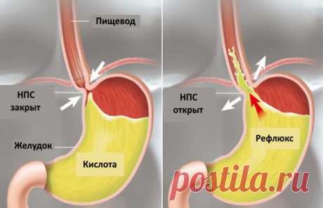 Как лечить рефлюкс: 8 советов Рефлюкс подразумевает серию симптомов, которые появляются у пациента тогда, когда кислые желудочные соки из желудка попадают в пищевод и ростовую полость.
Как правило, страдающие рефлюксом пациенты жа…