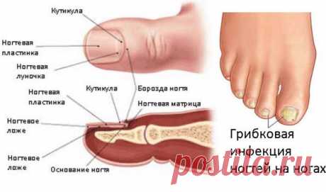 Как лечить грибок на ногтях ног