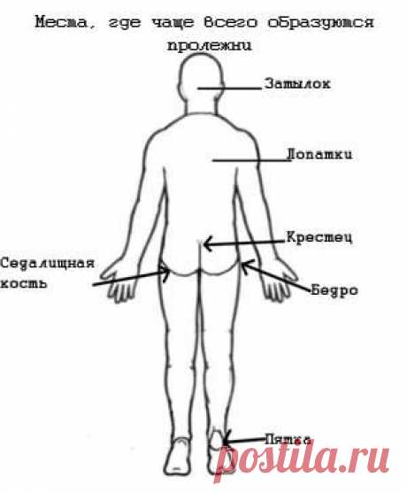 Пролежни - лечение, причины и профилактика. | Познавательный сайт ,,1000 мелочей&quot;