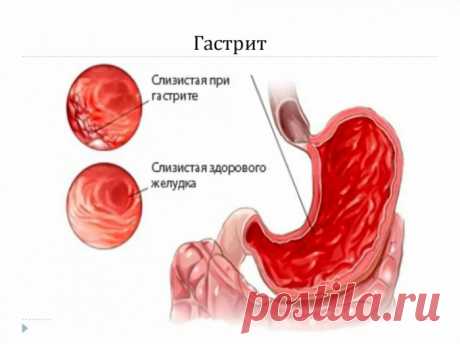 Лечение гастрита в домашних условиях.