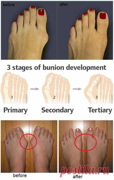 How to Prevent and Treat Bunions - AllDayChic