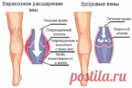 Чего боится варикоз: эффективные народные методы лечения