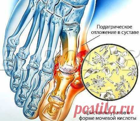 РЕЦЕПТЫ НАРОДНОЙ МЕДИЦИНЫ ПРИ ОТЛОЖЕНИИ СОЛЕЙ.