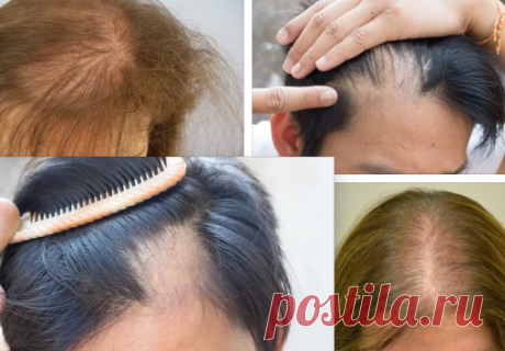 Причины выпадения волос: народные рецепты, которые помогут в лечении облысения, результат гарантирован | СИНИЙ ЦВЕТОК-мотивация к идеалу | Яндекс Дзен