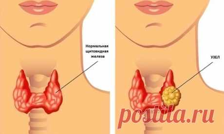 Каша, которая способна вылечить щитовидку!