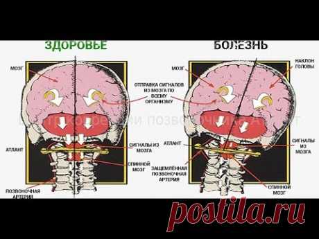 Симптомы смещения Атланта. Инструментальная диагностика шеи