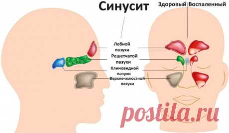 Избавьтесь от воспаления носовых пазух в течение 20 секунд с помощью этого простого метода, и всего одного ингредиента 
Если вы страдаете от воспаления носовых пазух и не хотите прибегать к обычным методам лечения, то вы можете попробовать простой рецепт, состоящий из одного ингредиента — яблочный уксус.
Ваш синусит я…