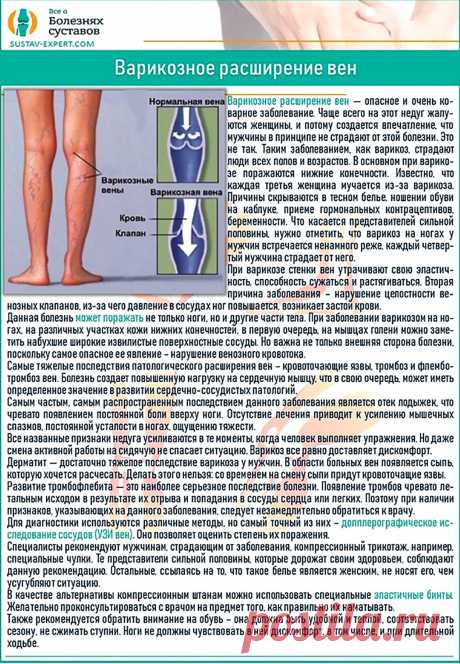 Варикозное расширение вен