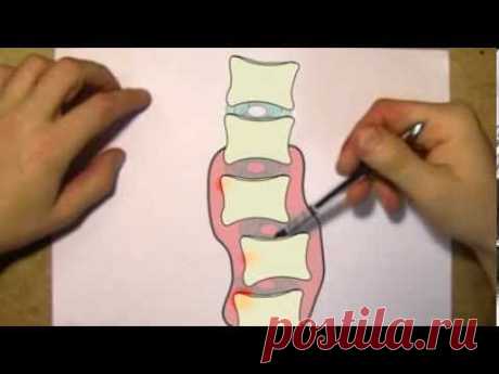 Как жить с остеохондрозом полноценной жизнью Что такое остеохондроз на самом деле