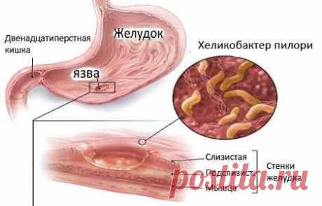 Хеликобактер пилори лечение народными средствами, методы | Sovetcik.ru