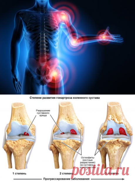 Артрит-артроз - как лечить без операции и лекарств?!