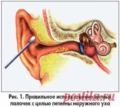 Серные пробки в ушах и их правильное удаление!