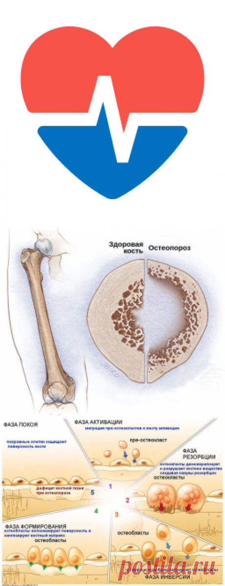 Остеопороз: что это, симптомы, диагностика, лечение болезни в статье терапевта Веретюк В. В.