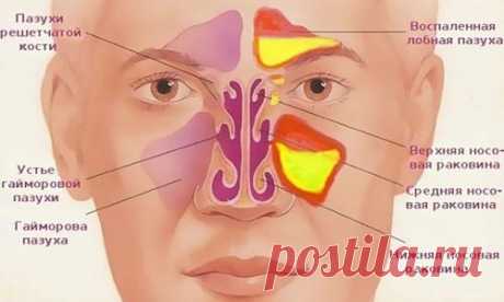 Как очистить гайморовые и лобные пазухи от гноя и слизи