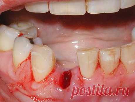 Какие зубы легче удалять верхние или нижние