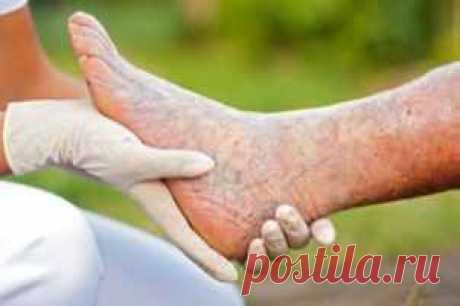 Грибок на ногтях ног, лечение для пожилых.