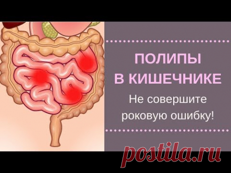 Полипы В Кишечнике.  Не совершите роковую ошибку!