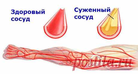 Чистые сосуды: 5 золотых рецептов от травника. Лечение атеросклероза - медиаплатформа МирТесен Многие люди с возрастом начинают испытывать неприятное ощущение, когда по ночам немеют пальцы рук и ног. Зачастую эти признаки свидетельствуют о развитии атеросклероза кровеносных сосудов. Атеросклероз — это одно из самых серьезных сердечных заболеваний, когда стенки сосудов уплотняются, а в местах