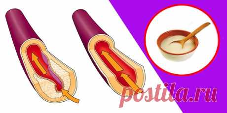 БЛОГ ПОЛЕЗНОСТЕЙ: Атеросклероз? Лечим, пока не поздно!
