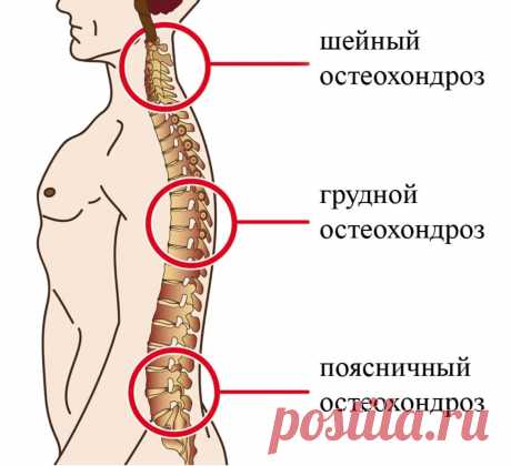 У меня остеохондроз 😰 что делать? | Доктор Иоланта | Дзен