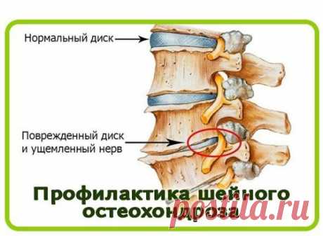 Одноклассники    ПРОФИЛАКТИКА ОСТЕОХОНДРОЗА ШЕЙНОГО ОТДЕЛА ПОЗВОНОЧНИКА.