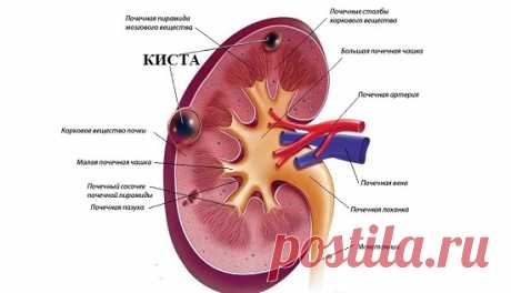 Что делать, чтобы рассосалась киста на почке: лечение у женщин и мужчин