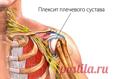 Плексит плечевого сустава - симптомы болезни, профилактика и лечение Плексита плечевого сустава, причины заболевания и его диагностика на EUROLAB
